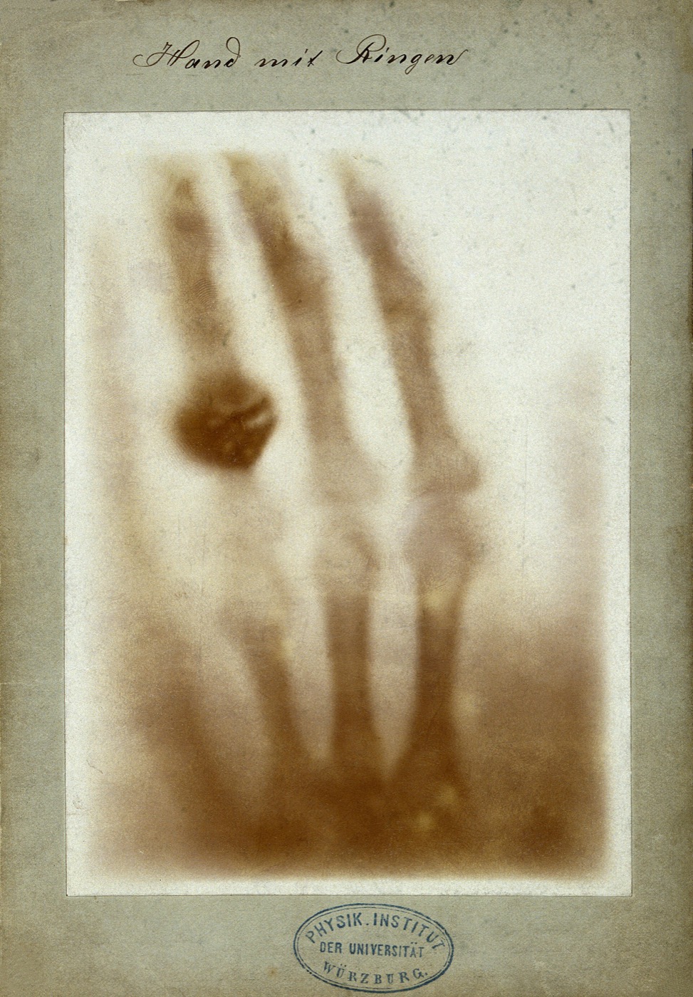 Röntgenaufnahme einer Hand mit Ringen