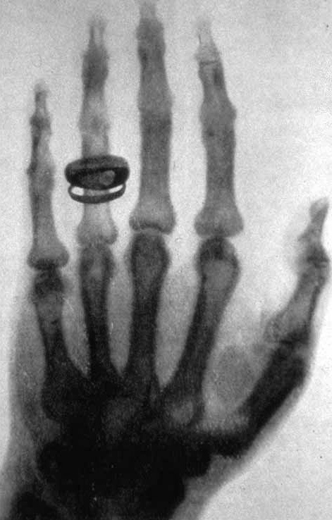 Röntgenaufnahme der Hand Albert von Köllikers, 1896